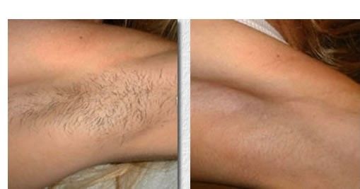 ipl laser hair removal
